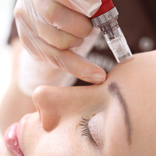 Microneedling